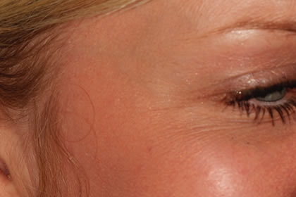 Crows feet example after
