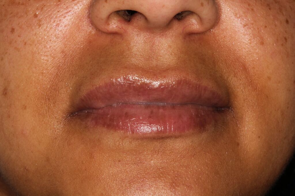 Lip filler example after