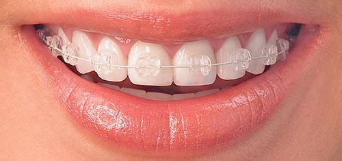 Ceramic clear braces