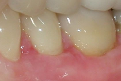Gingival Grafting Example After