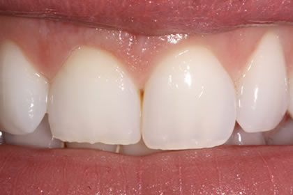 Crown Lengthening Example After