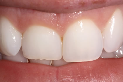 Crown Lengthening Example Before